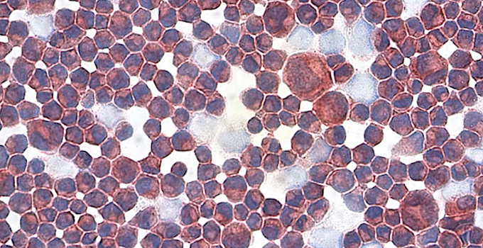 melanoma-cells